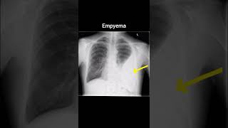 Empyema xray radiology röntgen thorax empyema [upl. by Kurtzman]