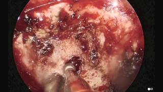 Petrous Apex Granuloma Drained Trans Nasal Endoscopic [upl. by Einomrah]