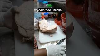 calcified uterus  histopathology [upl. by Cathyleen432]