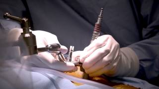 Minimally Invasive Laminectomy Surgery to Treat Lumbar Stenosis  MedStar Southern Maryland [upl. by Feilak]