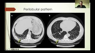 Reticular opacities in HRCT part 1 Arabic version [upl. by Adlig]