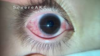 Severe AKC Atopic keratoconjunctivitis [upl. by Petersen604]