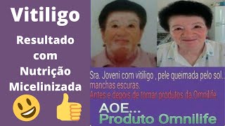 Vitiligo  Resultados com Produtos Omnilife da Sra Joveni Nutrição Micelinizada [upl. by Alleunam]