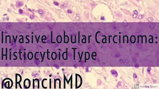 Short Review Invasive Lobular Carcinoma Breast  Histiocytoid Type [upl. by Halona]