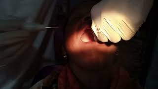 very big pain and sensivity problem upper left side 2nd molars RCT process 1 [upl. by Zerep]