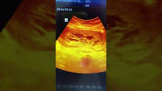 Hydatidiform mole HM ultrasound shorts shortvideo [upl. by Eelnodnarb]