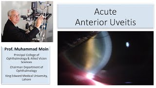 What do you see in Acute Anterior Uveitis [upl. by Kcirdderf]