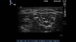 Ultrasound guided Interscalene Brachial plexus Block [upl. by Chatterjee]