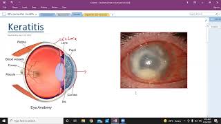 Keratitis  types of keratitis  Ophthalmology  USMLE step 1 [upl. by Esille]