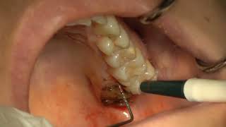 Palatal Fibrous Hyperplasia Excision [upl. by Llenahc]