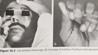 method of holding THUDICUM NASAL SPECULUM Nose examination [upl. by Adnilim724]