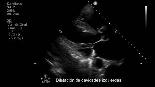 Miocardiopatía dilatada con fracción de eyección reducida [upl. by Yevrah]