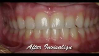 Invisalign Express with WhiteningBefore amp AfterMick Family Dental Care [upl. by Hertberg]