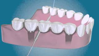 TePe Bridge amp Implant Floss zubní nit [upl. by Buroker665]