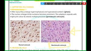 PNS Pathology Demyelinating disease of the CNS Mutah [upl. by Leontine]