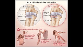 Annular Ligament Traction Trapping Displacement or Nursemaids Elbow Subluxation of Radial Head [upl. by Allista]