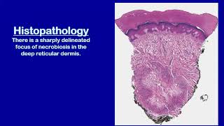 Lecture110 Necrobiotic Granulomatous Disorders of the Skin Rooks chapter 97 [upl. by Riehl]