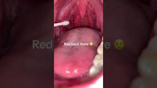 7 minutes Week 16 tonsilstar fyp foryou foryourpage tonsil tonsil tonsillar [upl. by Eesdnil387]