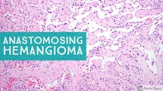 Anastomosing Hemangioma 101Explained by a Soft Tissue Pathologist [upl. by Brazee148]