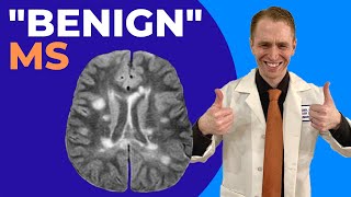 quotBenignquot Multiple Sclerosis Explained by Neurologist [upl. by Norej]