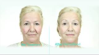 Dermawand International HD 2016 [upl. by Toh]