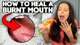 6 QUICK ways to HEAL a BURNT MOUTH [upl. by Egroj49]