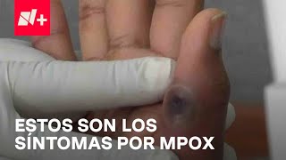 ¿Cuáles son los síntomas de Mpox Despierta [upl. by Akimad]