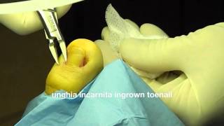 unghia incarnita  uña encarnada  ingrown toenail surgical treatment 向内生长趾甲 podologo [upl. by Cleres]