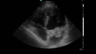 Atrial Myxoma Ultrasound JETem [upl. by Batish742]