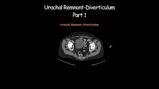 Urachal RemnantDiverticulum Part 1 radiology radiologist embryology urinarybladder [upl. by Minni]