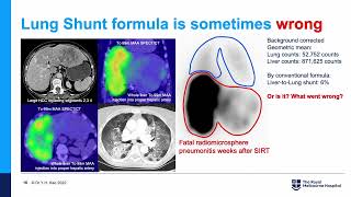 Yttrium90 Radioembolization Selective Internal Radiation Therapy Y90 SIRT Radioembolisation TARE [upl. by Craven]