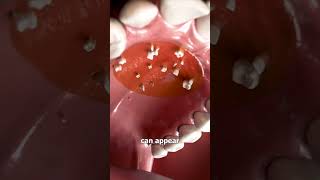 Hyperdontia Extra Teeth in the Roof of Your Mouth Learn About This Condition   Cosmodent India [upl. by Eelamme]