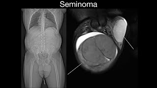 Seminoma [upl. by Beitch]