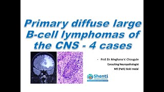 Primary Diffuse Large Bcell Lymphoma of the CNS  4 cases [upl. by Norri]