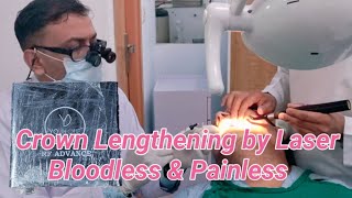 capping of teeth crown Lengthening by Laser Bloodless amp Painless [upl. by Alaric]