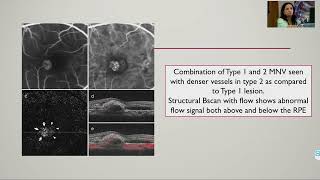 KSOS2022 3 Understanding Choroidal Neovascularisation Dr Manoj S [upl. by Kwon]