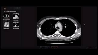 Anterior mediastinal masses beyond the mnemonic [upl. by Hermon]