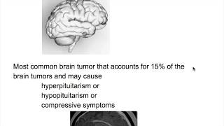 Pituitary Adenoma [upl. by Roz]