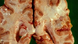 Cerebral Ischaemia and Infarction  Pathology mini tutorial [upl. by Hebbe]