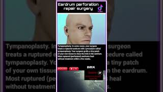 Eardrum perforation repair surgery [upl. by Taimi]