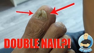 TRIMMING OF A DAMAGED THICKENED SPLIT TOENAIL WITHOUT REMOVAL [upl. by Leith292]