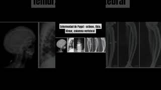 ENFERMEDAD DE PAGET CRÁNEO TIBIA FÉMUR COLUMNA VERTEBRAL  PELVIS [upl. by Atteynod]