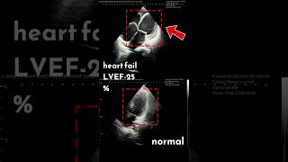 हार्ट पम्पिंग का कम होना What Does Heart Failure Look Like on an Echo [upl. by Nelon]