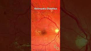 Retinopatia diabética proliferativa [upl. by Onirefes540]