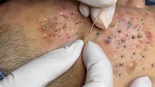 Treatment Of Blackheads And Hidden Acne 052 [upl. by Loftus]