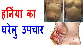 हर्निया का घरेलु उपचार  How to cure Hernia at home  Treatment of appendix  Hernia ka ilaaj [upl. by Anjali397]