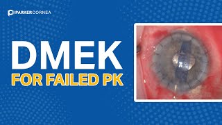 DMEK for Failed PK [upl. by Christal]