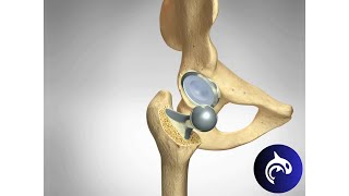 Quick View  Hip Replacement Hip Arthroplasty  3D Animation [upl. by Schulz260]