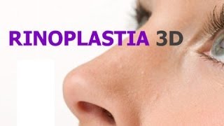 RINOPLASTIA CIRURGIA NARIZ RINOPLASTIA 3D ANTES DEPOIS [upl. by Melinda]