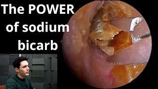 Angels Earwax Removal  Auburn Medical Group [upl. by Erehs228]